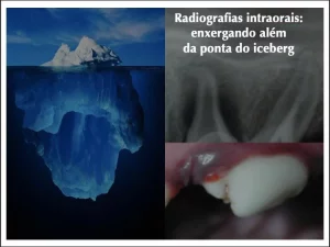 Radiografia Intraoral: Entenda a importância!