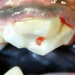 Fratura em lasca do 4º pré-molar superior direito, com exposição da polpa (ponto em vermelho). Indicação de tratamento de canal e restauração em resina.