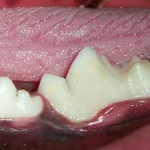 Dente primeiro molar inferior esquerdo após restauração com resina fotopolimerizável.