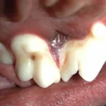 Cárie em fossa oclusal do primeiro molar superior esquerdo (ponto escuro no meio do dente).