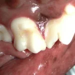 Aspecto final após remoção da cárie e restauração em resina do primeiro molar superior esquerdo.