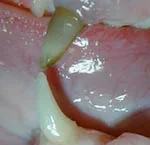 2) Canino superior esquerdo com fraturado com exposição da polpa (ponto escutro na ponta do dente) e escurecimento do dente que indicam morte da parte viva do dente. Indicação de tratamento de canal e restauração do dente.