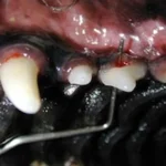 Sondagem periodontal do 2° pré-molar superior. A sonda passa por baixo do dente entre as raízes porque o osso foi destruído pela doença periodontal. Neste espaço entre as raizes a placa bacteriana se acumula e não pode ser removida com a escovação do dente e funciona como um foco de infecção.