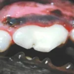 Dente quarto pré-molar superior direito após tratamento de canal e restauração em resina fotopolimerizável.