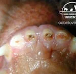 3) Dentes incisivos de cão gastos devido ao encaixe imperfeito dos dentes que levou a exposição da polpa destes dentes.