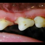 Área selecionada da imagem ao lado dos dentes 1°, 2° e 3° pré-molares superiores direitos com pequena retração gengival no 1° e 2° pré-molares.
