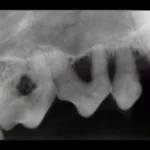 Radiografia intraoral do 1°, 2° e 3° pré-molares superiores direitos. Nota-se áreas escuras de grande perda óssea. Estes dentes funcionam como um foco de infecção e tem indicação de serem extraídos. Tudo isto poderia ter sido evitado com cuidados odontológicos em casa e avaliação/tratamento profissional regularmente.