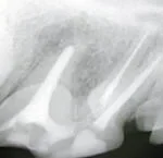 7) Imagem radiográfica do tratamento de canal das três raízes do quarto pré-molar superior direito.