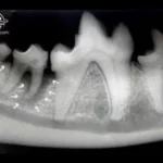 Radiografia intraoral do 1° e 2° molares inferiores. Setas brancas indicam área de perda óssea causada pela evolução da doença periodontal. O 2° molar está condenado a extração, o que poderia ter sido evitado com cuidados odontológicos em casa e avaliação/tratamento profissional regularmente.