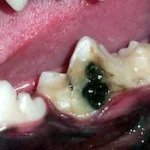 Defeito em esmalte no primeiro molar inferior esquerdo. Indicado restauração em resina.