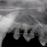 Radiografia intraoral do canino, 1°, 2° e 3° pré- molares superiores. Existe significativa perda de osso (linha pontilhada amarela – o osso deveria estar no nível da linha pontilhada branca) ao redor do 1° e 2° pré-molares, resultado da evolução da doença periodontal. Estes dentes funcionam como um foco de infecção e tem a indicação de serem extraídos durante um tratamento periodontal. Caso contrário, não é possível devolver a saúde bucal.