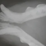 Radiografia intra-oral mostrando a ruptura da sínfese da mandíbula (queixo) do paciente felino.