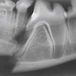 Radiografia intra-oral da região do dente 10 molar inferior mostra a fratura da mandíbula e também do dente. Dente precisa ser extraído e a fratura imobilizada.