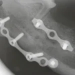 Fratura foi imobilizada com mini-placas de titanium. Imagem mostra a fratura já consolidada (não se vê mais a fratura).